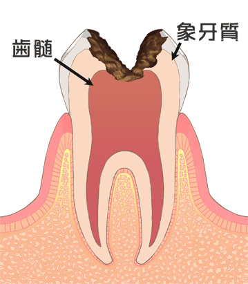 C3（重度）虫歯